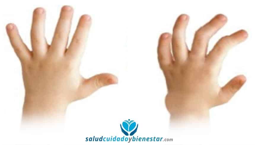 Anomalías y malformaciones de la mano en niños – La Clinodactilia