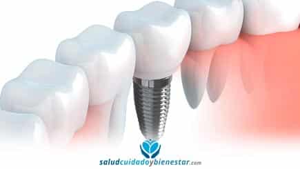 Implantes dentales, salud para tu boca con la tecnología más avanzada