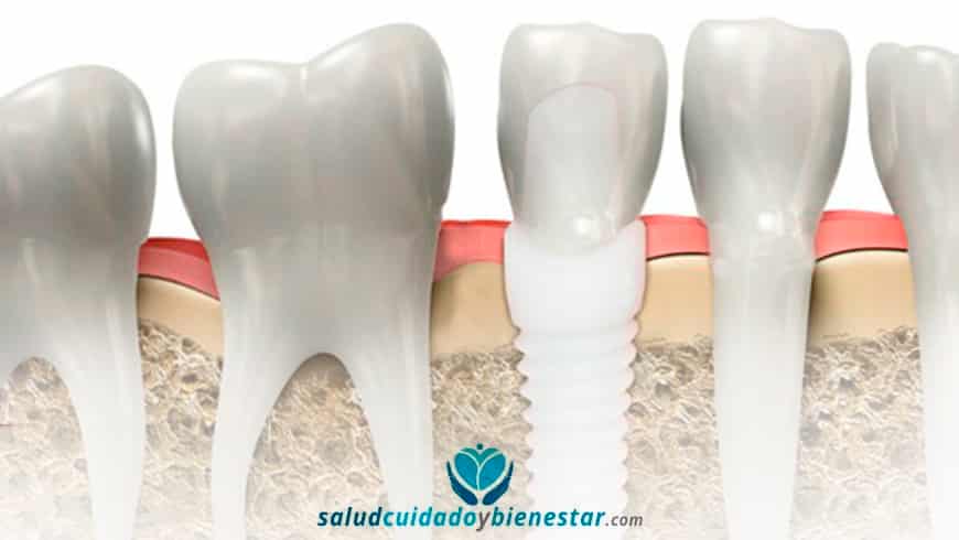 Implantes dentales de zirconio en un solo día y sin complicaciones