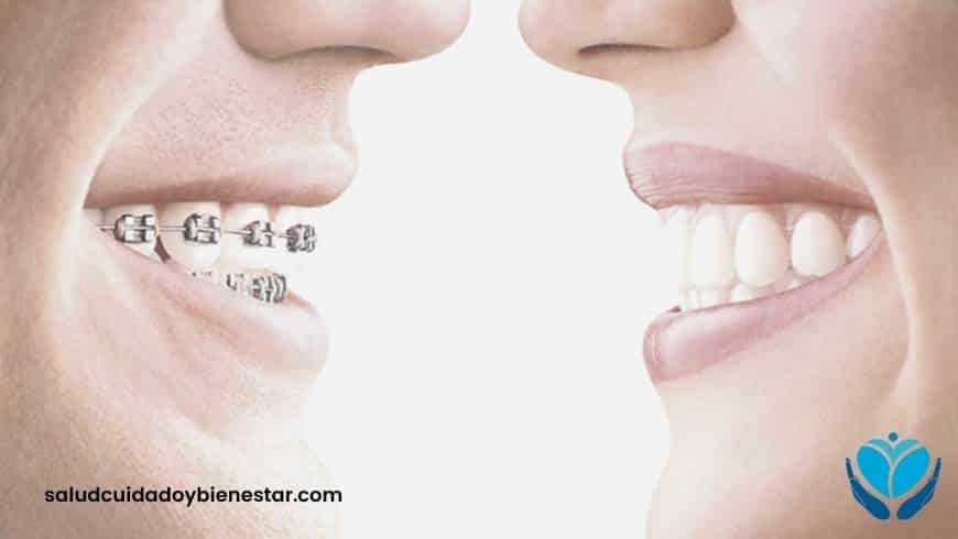 Ventajas de la ortodoncia invisible frente los brackets en adultos